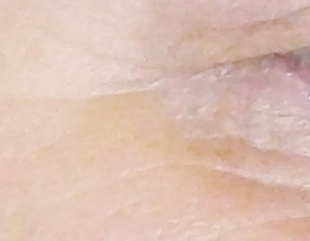 wrinkles - after