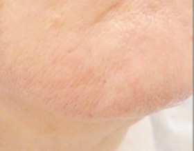 chin - after