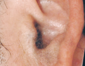 ears - after
