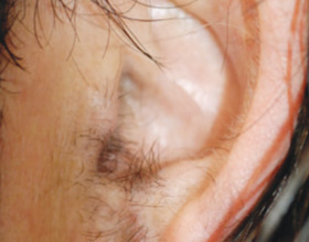 ears - before