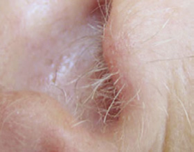 ears - after