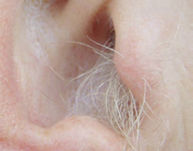 ears - before