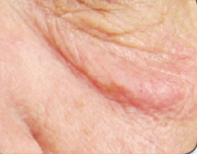 bags under the eye - before